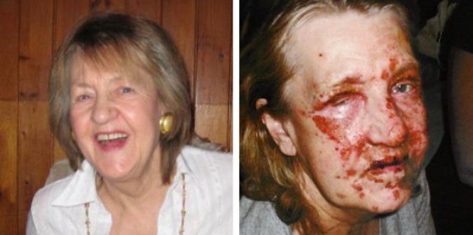 Example of the disfigurement drain cleaner accidents can cause. Photographs from http://www.dailyecho.co.uk/news/8253292.My_face_melted_when_drain_cleaner_exploded/